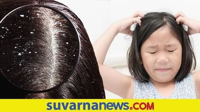 தலையில் பொடுகு தொல்லையா? முற்றிலும் ஒழித்து கட்ட இந்த ஒரு பொருளை பயன்படுத்துங்கள் போதும்.. 
