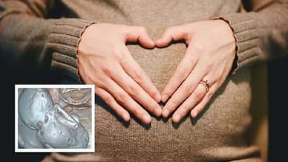 lithopedion |தாயின் வயிற்றில் கல்லாக மாறிய குழந்தை... 35 ஆண்டுகளுக்கு பின் அறுவைசிகிச்சை மூலம் அகற்றம்..!