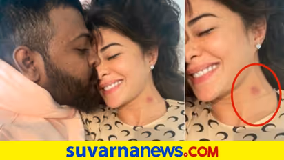 Jacqueline Fernandez Love Bite: ವೈರಲ್ ಲವ್ ಬೈಟ್ ಫೋಟೋ ಬಗ್ಗೆ ಜಾಕಿ ಹೇಳಿದ್ದಿಷ್ಟು