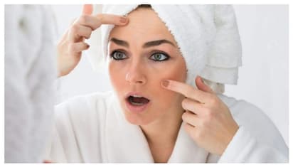 গরম পড়তেই মুখে ব্রণ-তে ভরে গেছে, ঘরোয়া টোটকায় দূরল করুন কালো দাগ ছোপ