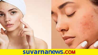 Skin Care: ಮೊಡವೆ ಕಲೆಯನ್ನು ಹೋಗಲಾಡಿಸಲು ಸುಲಭ ವಿಧಾನವಿದು