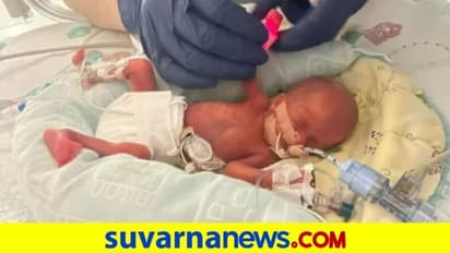 325 ಗ್ರಾಂ ತೂಕದ ಅತ್ಯಂತ ಸಣ್ಣ ಮಗುವಿಗೆ ಜನ್ಮ ನೀಡಿದ  17ರ ಬಾಲೆ
