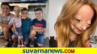 Adalia Rose Williams Death: 15ನೇ ವಯಸ್ಸಿಗೆ ಇಹಲೋಕ ತ್ಯಜಿಸಿದ ವೃದ್ಧೆ: ಏನಿದು ವಿಚಿತ್ರ ಕಾಯಿಲೆ?