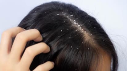 Home Remedies for Dandruff :  താരൻ അലട്ടുന്നുണ്ടോ? വീട്ടിലുണ്ട് മികച്ച പ്രതിവിധികൾ