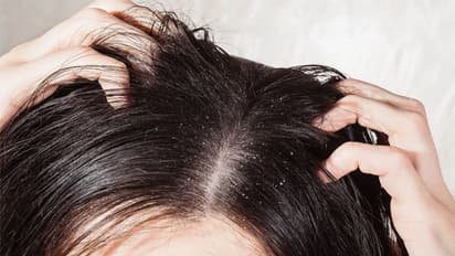 Dandruff :  താരൻ അകറ്റാൻ‌ ഇതാ ചില പ്രകൃതിദത്ത മാർ​ഗങ്ങൾ