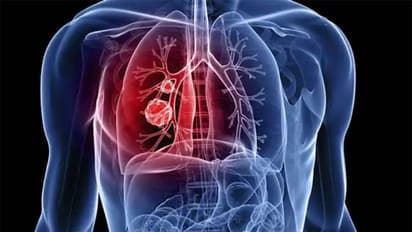 Lung Cancer: ಹೇಗೆ ಬೇಕಾದರೂ ಬರಬಹುದು, ಬಾರದಂತೆ ಹೀಗ್ ಮಾಡಿ!