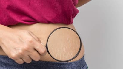 Stretch Marks: പ്രസവശേഷമുളള സ്ട്രെച്ച് മാർക്ക് മാറാൻ പരീക്ഷിക്കാം ഈ എളുപ്പ വഴികൾ...