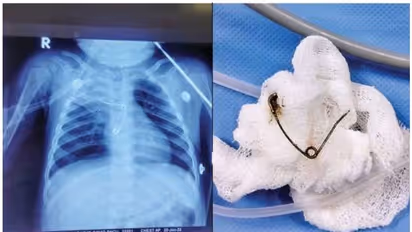 സേഫ്റ്റിപിന് അന്നനാളത്തില് കുടുങ്ങി പിഞ്ചുകുഞ്ഞ്; ജീവന് തിരിച്ചുപിടിച്ച് തൃശൂര് മെഡിക്കല് കോളേജ്