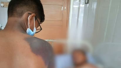 വെള്ളമാണെന്ന് കരുതി രാസവസ്തു കുടിച്ചു; വായയും തൊണ്ടയും പൊള്ളിയ വിദ്യാർത്ഥി ആശുപത്രിയിൽ