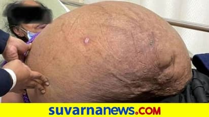ಮಹಿಳೆಯ ದೇಹದಿಂದ 47 ಕೆಜಿ ತೂಕದ ಬೃಹತ್‌ ಗಡ್ಡೆಯನ್ನು ಶಸ್ತ್ರಚಿಕಿತ್ಸೆ ಮಾಡಿ ತೆಗೆದ ವೈದ್ಯರು