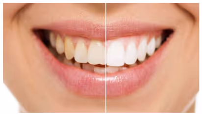 Teeth whitening: பற்களில் மஞ்சள் கறையை போக்கும் ஈஸியான 6 வழிமுறைகள்! இனி ஸ்மைல் பண்ணலாம்..!!