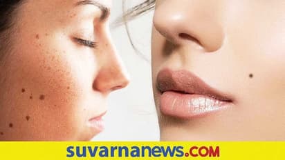 Skin and Fleck: ಬ್ಯೂಟಿ ಸ್ಪಾಟ್ ಆಯ್ತು ಕ್ಯಾನ್ಸರ್ ಸೂಚಕ