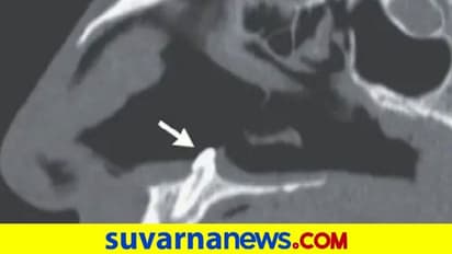 ವರ್ಷದಿಂದ ಉಸಿರಾಟಕ್ಕೆ ಕಷ್ಟ ಪಡುತ್ತಿದ್ದ ವ್ಯಕ್ತಿ... ಎಕ್ಸರೇ ಮಾಡಿದಾಗ ಮೂಗಿನೊಳಗಿದ್ದಿದೇನು ನೋಡಿ