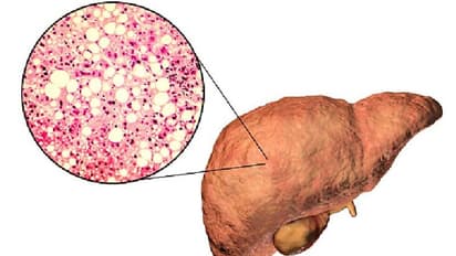 Do you have fatty liver? Know how this disease may result in insulin resistance