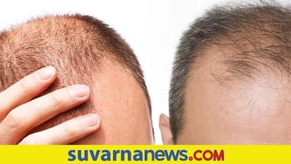 Hair Loss : ತಲೆ ಬೋಳಾಗ್ಬಾರದಂದ್ರೆ ಇದರ ಸೇವನೆ ಕಡಿಮೆ ಮಾಡಿ