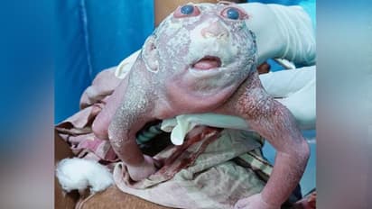 इस बच्चे को ध्यान से देखिए, जिसे महिला ने दिया जन्म, मेंढक जैसी शक्ल, लेकिन गर्दन नहीं..फिर जो हुआ वो शॉकिंग