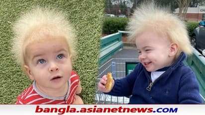 জল লাগলেও ভেজে না চুল, যায় না আচড়ানোও - বিরল রোগে আক্রান্ত মার্কিন শিশু