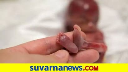 40 ದಿನದ ಶಿಶುವಿನ ಹೊಟ್ಟೆಯಲ್ಲಿ ಭ್ರೂಣ, ವೈದ್ಯಲೋಕಕ್ಕೆ ಅಚ್ಚರಿ!