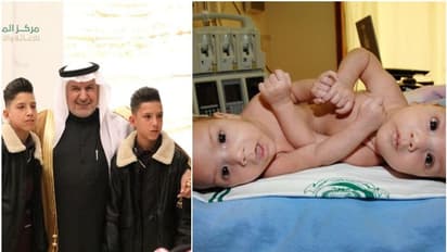 Conjoined Twins : വേര്പെടുത്തിയ ഡോക്ടറെ കാണാന് 12 വര്ഷത്തിന് ശേഷം ജോര്ദാനിയന് സയാമീസുകളെത്തി