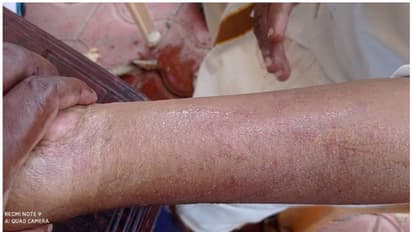 Kerala Climate Change : ചൂട് കനക്കുന്നു; പുനലൂരിൽ നഗരസഭ കൗൺസിലർക്ക് സൂര്യാതപമേറ്റു