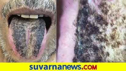 Hair On Tongue: ನಾಲಿಗೆ ಮೇಲೂ ಕೂದಲು ಹುಟ್ಟುತ್ತೆ, ಇದೆಂಥಾ ವಿಚಿತ್ರ ಕಾಯಿಲೆ !