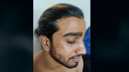 തൃശ്ശൂരിൽ ബിരുദ വിദ്യാർത്ഥിക്ക് റാഗിങ്ങിൻ്റെ പേരിൽ മർദ്ദനം