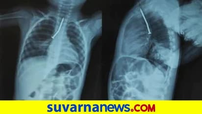 ಕಬ್ಬಿಣದ ಮೊಳೆ ನುಂಗಿದ 2 ವರ್ಷದ ಕಂದ: ವೈದ್ಯರಿಂದ ಶಸ್ತ್ರಚಿಕಿತ್ಸೆ