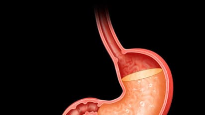 গরমে অ্যাসিডিটির সমস্যা বেড়েছে, তবে উপকার পাবেন এই জিনিসগুলো থেকে