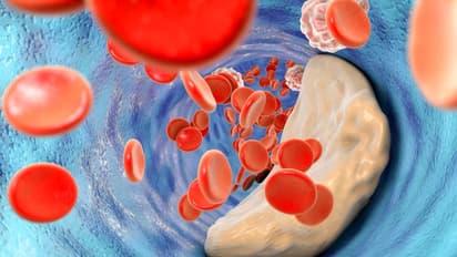 ഉയർന്ന കൊളസ്ട്രോളിന്റെ നാല് പ്രധാനപ്പെട്ട ലക്ഷണങ്ങൾ