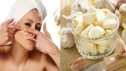 Beauty Tips: அழகான முகத்தில் ஆங்காங்கே கரும்புள்ளிகள்; கவலையை விடுங்க; சிம்பிள் பியூட்டி டிப்ஸ் இதோ!!