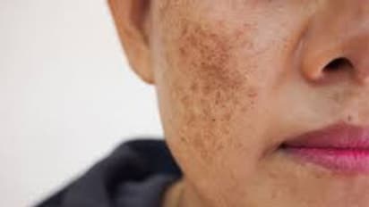 మంగు మచ్చలను తగ్గించే అద్భుతమైన ఇంటి చిట్కాలు.. అవేంటంటే?