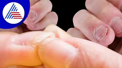 Health Tips: గోర్ల రంగు ఇలా మారిందా? అయితే జాగ్రత్త వహించాల్సిందే..