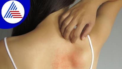 ಬೇಸಿಗೆಯಲ್ಲಿ ಕಾಟ ಕೊಡೋ ಬೆವರುಗುಳ್ಳೆ ಬರದಿರಲು ಹೀಗೆ ಮಾಡಿ ಸಾಕು