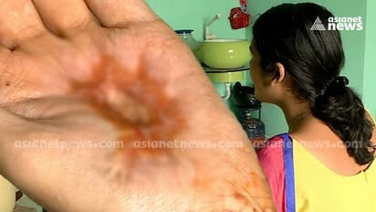 'ദേഹത്ത് ബാധുണ്ടെന്ന് പറഞ്ഞു, കയ്യിൽ കർപ്പൂരം വച്ച് കത്തിച്ചു'; പരാതിയുമായി ട്രാൻസ് യുവതി