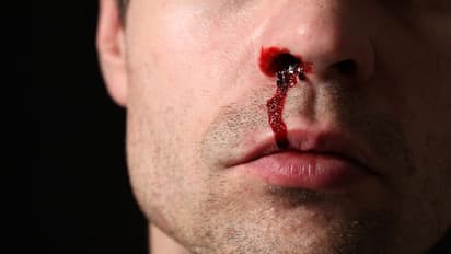 নাক দিয়ে রক্তক্ষরণের সমস্যায় ভুগছেন, এই ঘরোয়া টোটকায় মিলতে পারে সমাধান