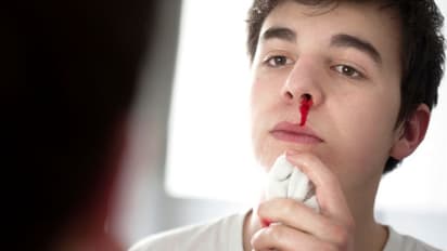 ముక్కు నుంచి రక్తం ఎందుకు కారుతుందో తెలుసా?