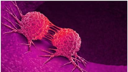 Cancer :  ഇന്ത്യക്കാർക്കിടയിൽ ഈ ക്യാൻസർ ബാധിക്കുന്നവരുടെ എണ്ണം കൂടി വരുന്നതായി വിദ​ഗ്ധർ