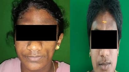 அட கடவுளே.. இப்படி ஒரு நோயா..! 20 வயசுல 45 மாதிரி இருக்கு.. அவதிப்படும் இளம்பெண்..