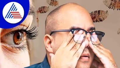 ವ್ಯಕ್ತಿಯ ಕಣ್ಣಿನೊಳಗಿತ್ತು ಒಂದು ಡಜನ್ಗೂ ಹೆಚ್ಚು ನೊಣಗಳ ಮೊಟ್ಟೆ !