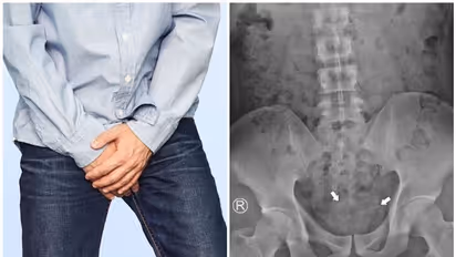 ലിംഗത്തിൽ ഇയർഫോണിന്റെ വയർ തിരുകിക്കയറ്റി യുവാവ്; മണിക്കൂറുകൾക്ക് ശേഷം സംഭവിച്ചത്