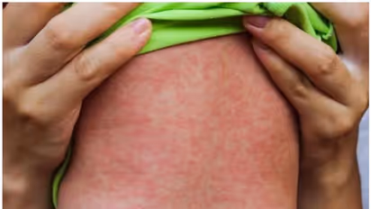 അമേരിക്കയിൽ ഒരു പതിറ്റാണ്ടിന് ശേഷം വീണ്ടും അഞ്ചാം പനി മരണം; വാക്സിനെടുക്കാത്ത കുട്ടി മരിച്ചെന്ന് സ്ഥിരീകരണം