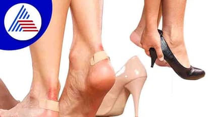 Home Remedies : ಚಪ್ಪಲಿ ಕಚ್ಚಿ ಗಾಯವಾಗಿದ್ಯಾ? ಹಾಗಿದ್ರೆ ಈ ಟಿಪ್ಸ್ ಬಳಸಿ