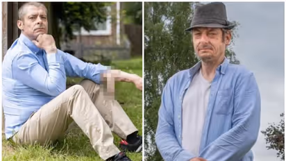 Penis : കയ്യിൽ ലിം​ഗവുമായി യുവാവ് ജീവിച്ചത് 6 വർഷം; ഒടുവിൽ ശസ്ത്രക്രിയയിലൂടെ യഥാസ്ഥാനത്ത് തുന്നിച്ചേർത്തു