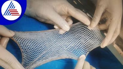 Bengaluru: ಆ್ಯಸಿಡ್ ಸಂತ್ರಸ್ತೆಗೆ ವಿಕ್ಟೋರಿಯಾ ಸ್ಕಿನ್ ಬ್ಯಾಂಕ್ನಿಂದ ಚರ್ಮ ರವಾನೆ..!