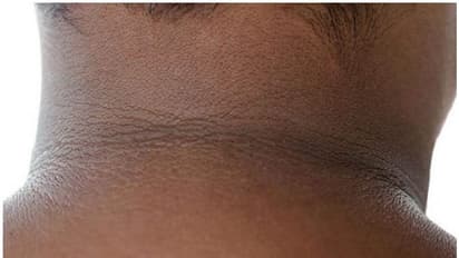 ঘাড়ের কালো পুরু দাগ তুলতে কাজে লাগান লবন, দ্রুত মিলবে উপকার