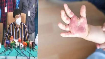 கேரளாவில் பரவும் தக்காளி வைரஸ்.. தக்காளில் இருந்து வைரஸ் பரவுமா..? சுகாதாரத்துறை செயலர் விளக்கம்..