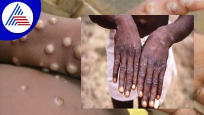 ಒಂದೊಂದೇ ದೇಶಕ್ಕೆ ಲಗ್ಗೆ ಇಡುತ್ತಿದೆ ಮಂಕಿಪಾಕ್ಸ್ !