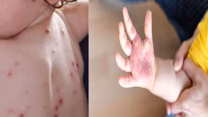 आखिर क्या है टोमैटो फीवर, बच्चों के लिए क्यों खतरनाक यह, क्या हैं टोमैटो फीवर के लक्षण और बचाव?