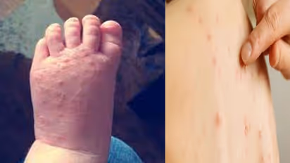 Tomato Fever :  തക്കാളിപ്പനി വ്യാപിക്കുന്നു; ലക്ഷണങ്ങൾ എന്തൊക്കെ? എങ്ങനെ പ്രതിരോധിക്കാം?