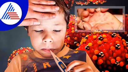 ಮಕ್ಕಳನ್ನು ಕಾಡುತ್ತಿದೆ ಟೊಮೆಟೊ ಜ್ವರ, ರೋಗ ಲಕ್ಷಣಗಳು ಯಾವುವು ? ಚಿಕಿತ್ಸೆಯೇನು ?